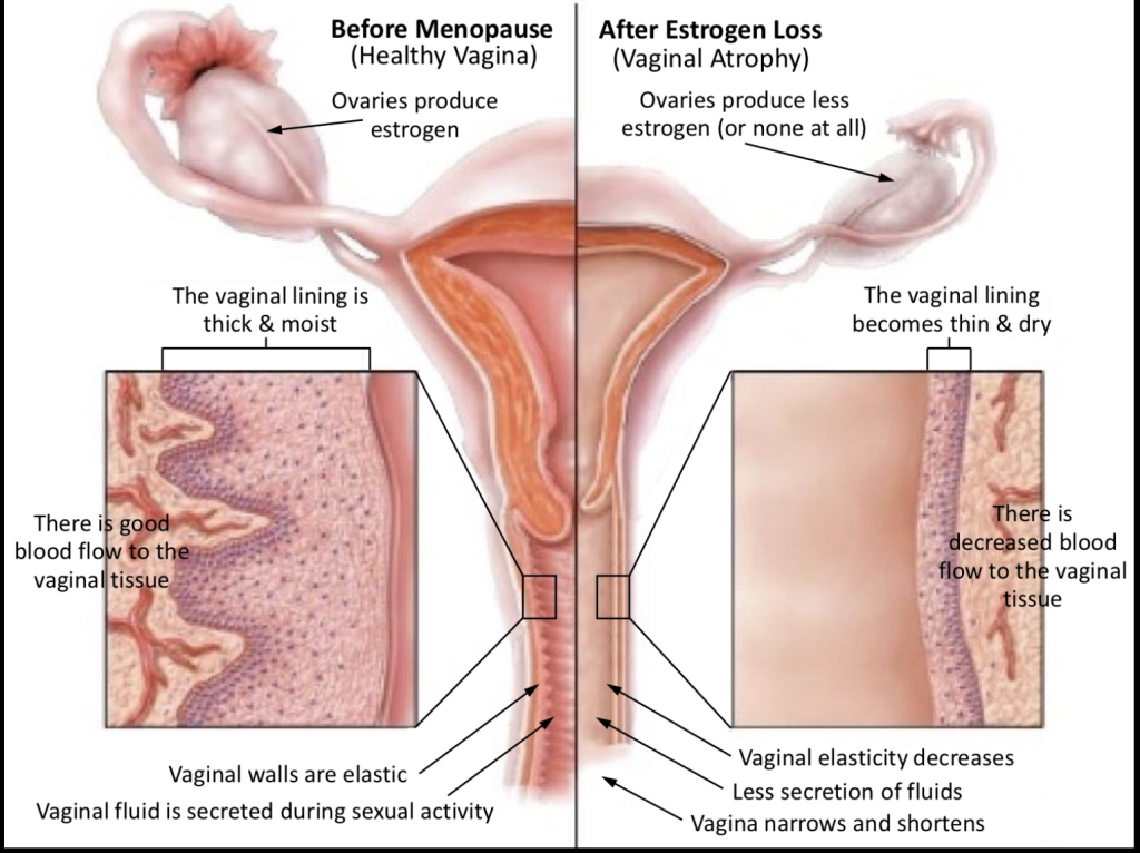 Vaginal tissue changes before and after menopause showing reduced elasticity and hydration