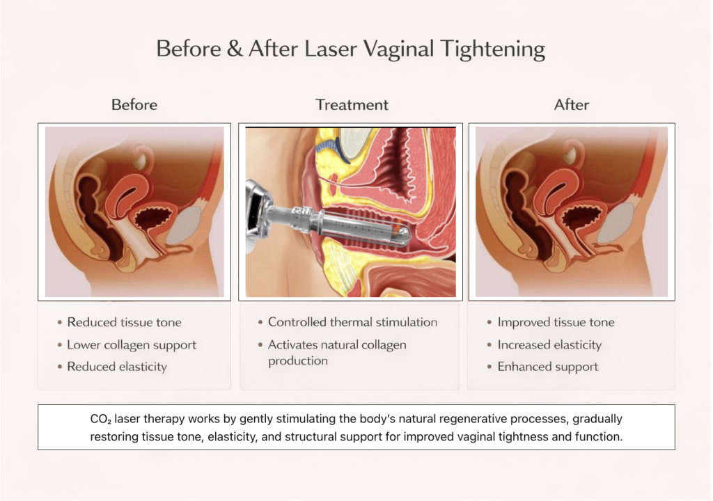 Illustration of vaginal tightening treatment results before and after CO2 laser therapy